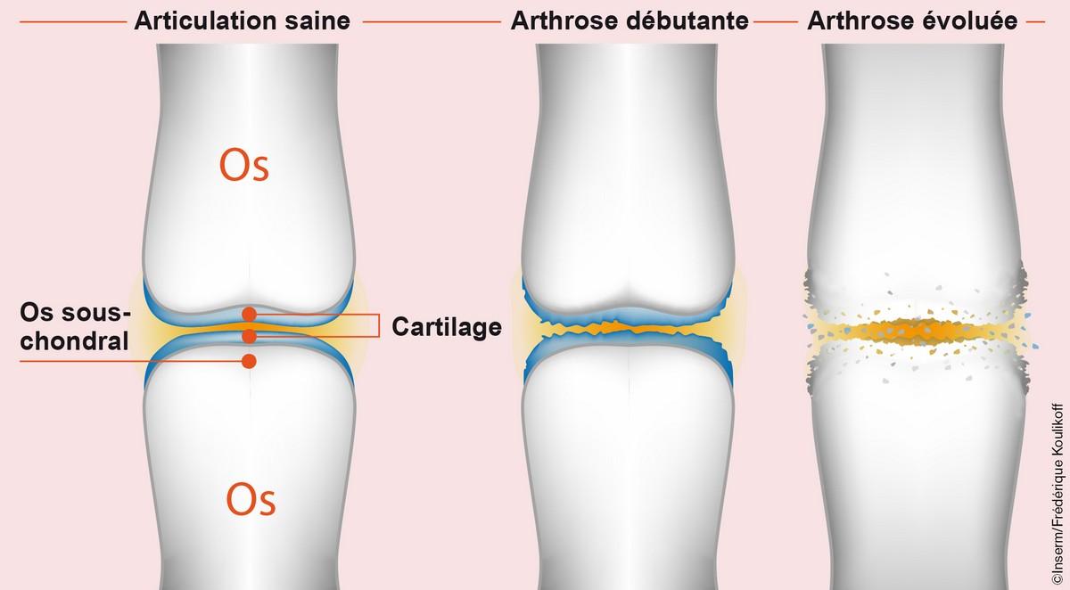 Des implants intelligents pour réparer le cartilage Des implants intelligents pour réparer le cartilage