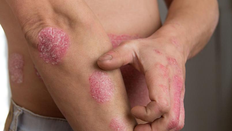 Psoriasis: gare aux médicaments qui peuvent l’aggraver Psoriasis: gare aux médicaments qui peuvent l’aggraver