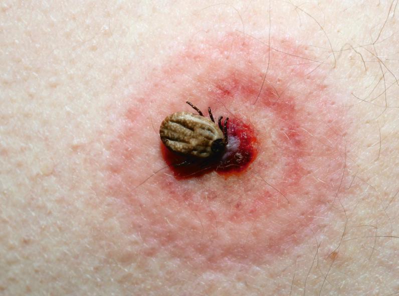 Maladie de Lyme : symptômes à surveiller après une piqûre de tique Maladie de Lyme : symptômes à surveiller après une piqûre de tique